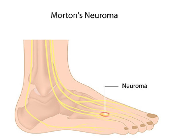 Morton's neuroma deals