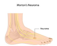 What Are the Treatments for Morton's Neuroma?