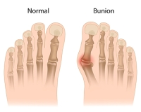 Bunion Complications