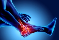 What Is Arthritis of the Foot?
