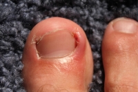 Why It Is Important to Trim Your Toenails Properly