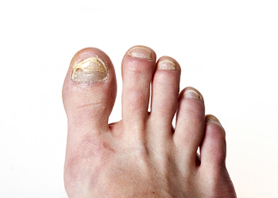 What Causes Toenail Fungus and How Can I Get Rid of It?: Jennifer Tauber,  DPM: Podiatrist
