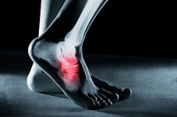 Stress Fractures and Their Impact on the Feet